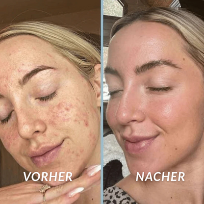 PeelShot - Reis Peeling