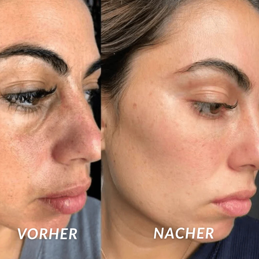 PeelShot - Reis Peeling